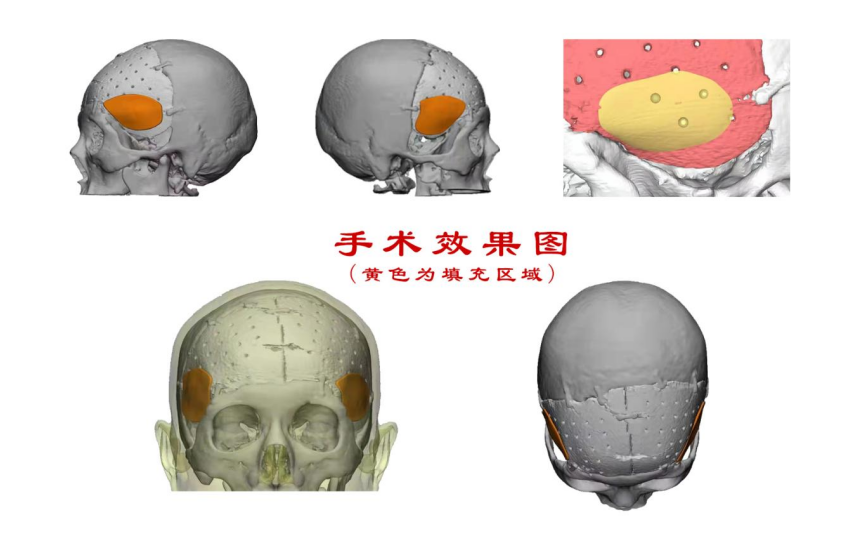 林志穎車禍致顏面骨折，醫(yī)生：或可用3D打印建模進(jìn)行術(shù)后修復(fù)